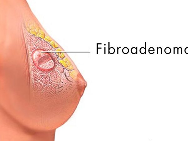 Fibroadenoma Treatment in Laxmi Nagar, East Delhi