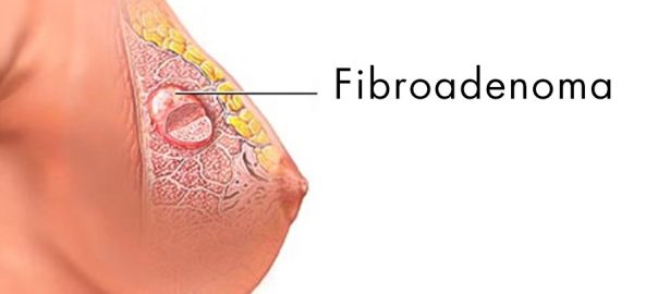 Fibroadenoma Treatment in Laxmi Nagar, East Delhi