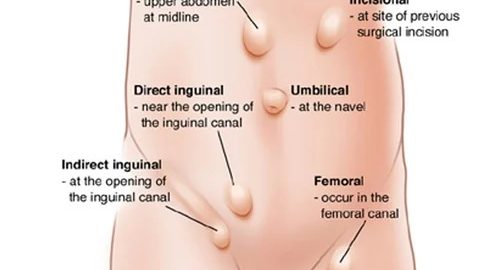 hernia surgery in East Delhi